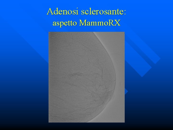 Adenosi sclerosante: aspetto Mammo. RX 