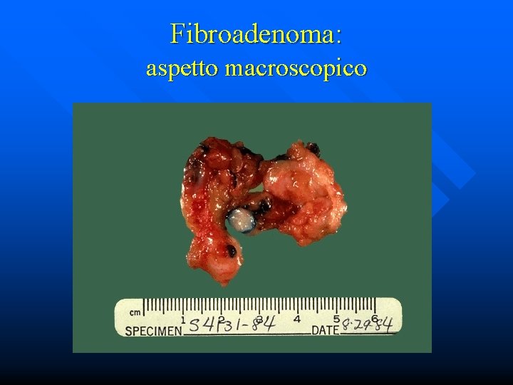 Fibroadenoma: aspetto macroscopico 