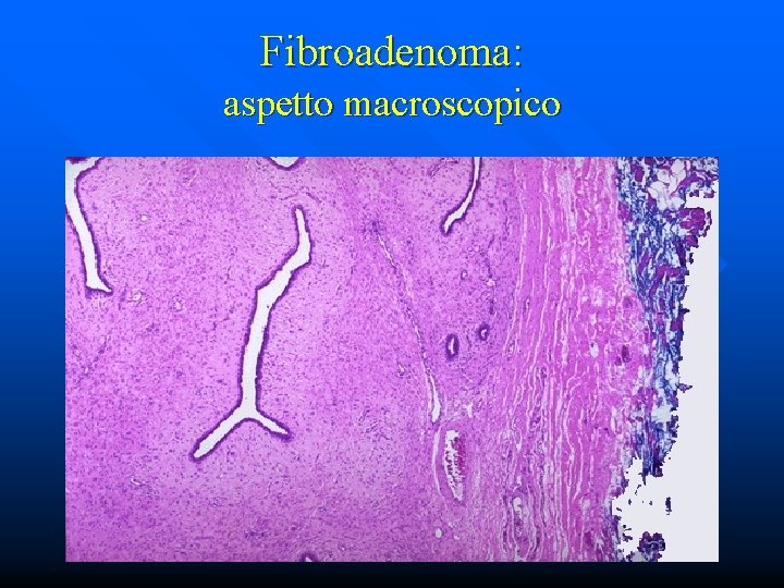 Fibroadenoma: aspetto macroscopico 