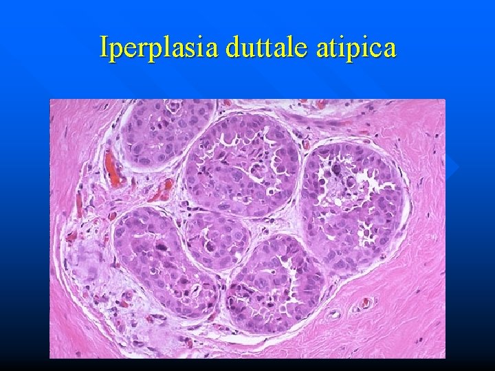 Iperplasia duttale atipica 