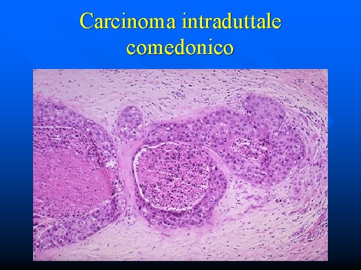 Carcinoma intraduttale comedonico 