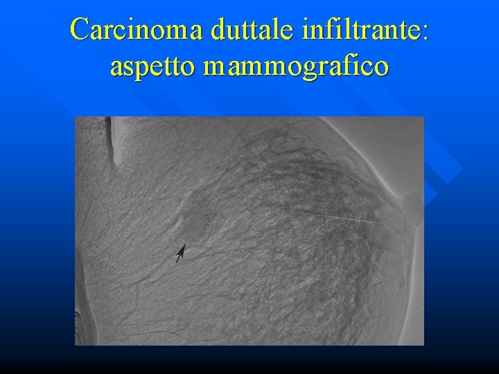 Carcinoma duttale infiltrante: aspetto mammografico 