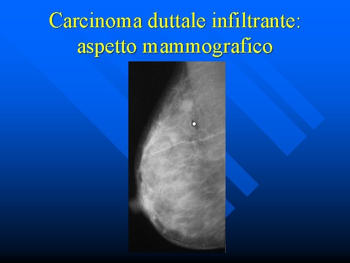 Carcinoma duttale infiltrante: aspetto mammografico 