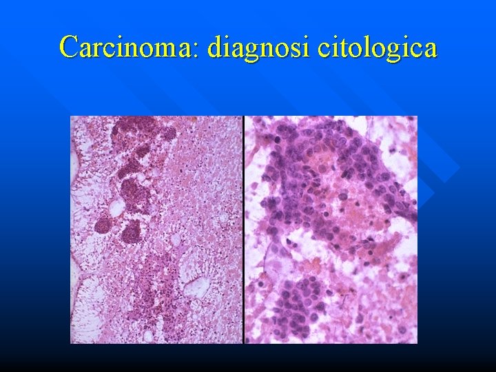 Carcinoma: diagnosi citologica 