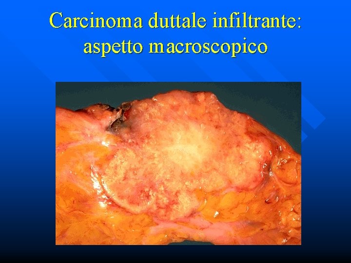 Carcinoma duttale infiltrante: aspetto macroscopico 
