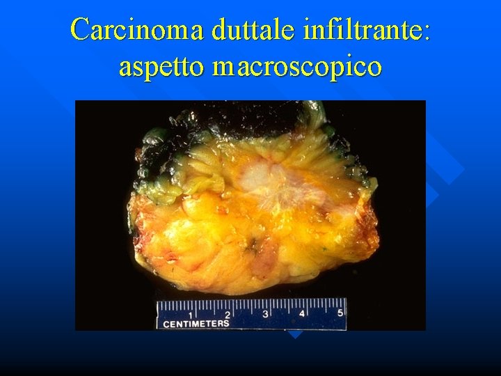 Carcinoma duttale infiltrante: aspetto macroscopico 