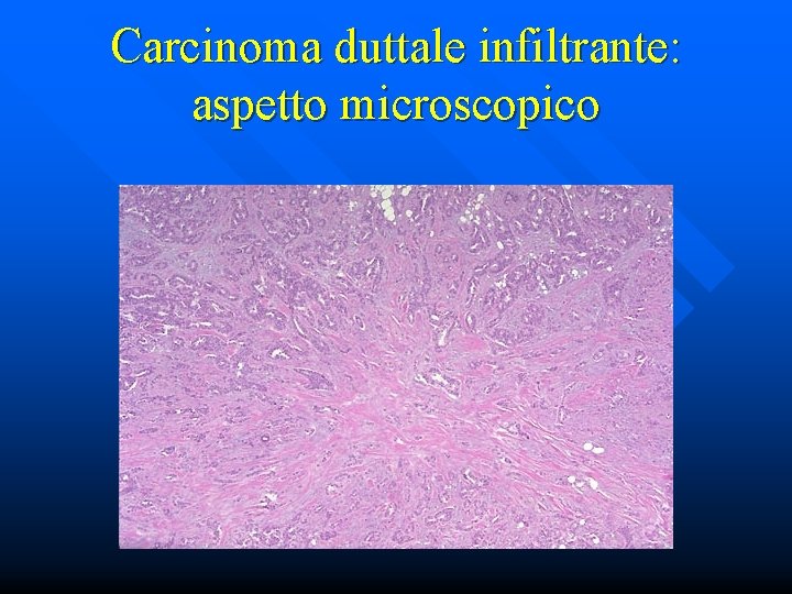 Carcinoma duttale infiltrante: aspetto microscopico 
