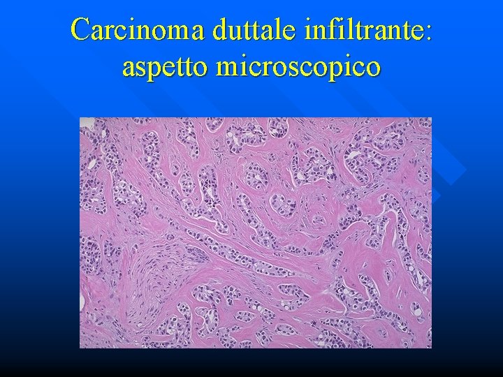 Carcinoma duttale infiltrante: aspetto microscopico 