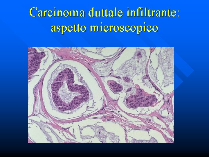 Carcinoma duttale infiltrante: aspetto microscopico 