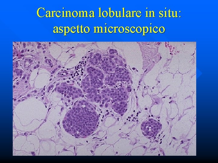 Carcinoma lobulare in situ: aspetto microscopico 