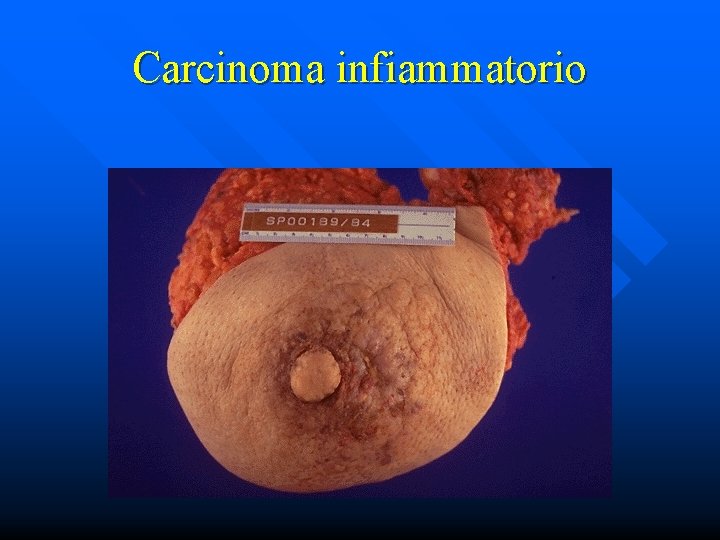 Carcinoma infiammatorio 