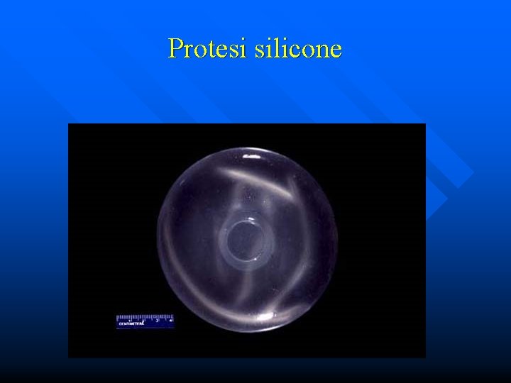 Protesi silicone 