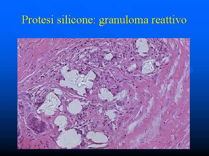 Protesi silicone: granuloma reattivo 