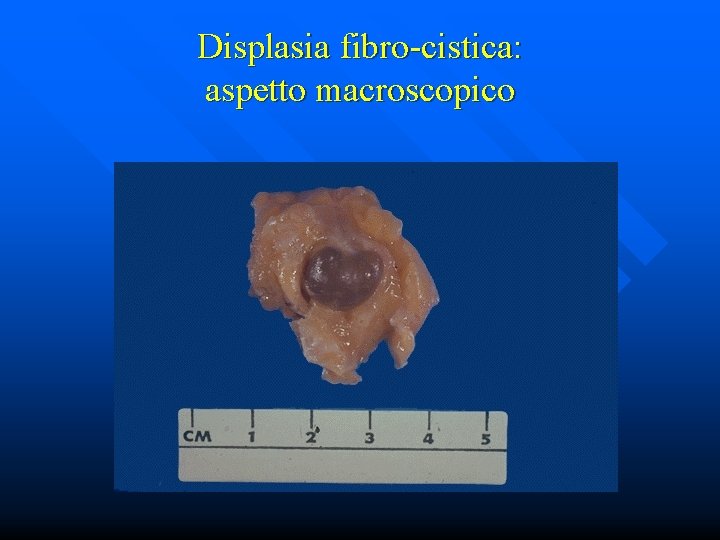 Displasia fibro-cistica: aspetto macroscopico 