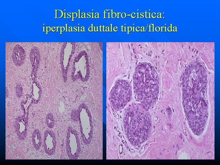 Displasia fibro-cistica: iperplasia duttale tipica/florida 