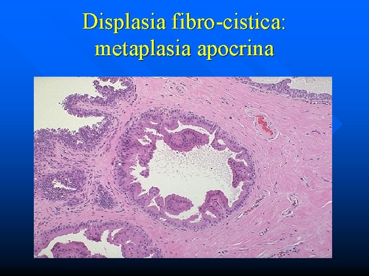 Displasia fibro-cistica: metaplasia apocrina 