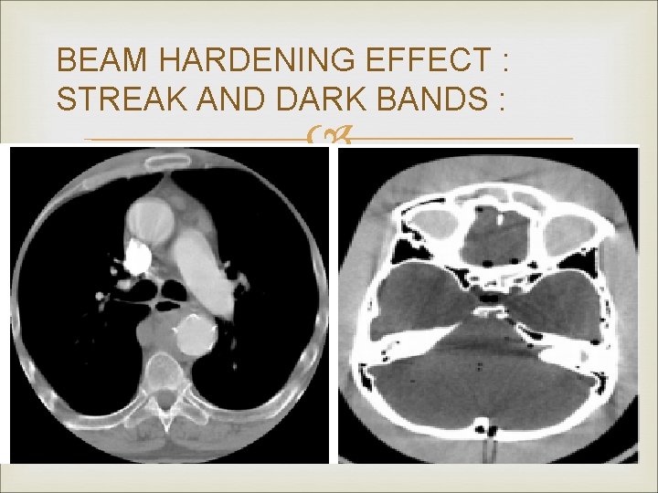 BEAM HARDENING EFFECT : STREAK AND DARK BANDS : 