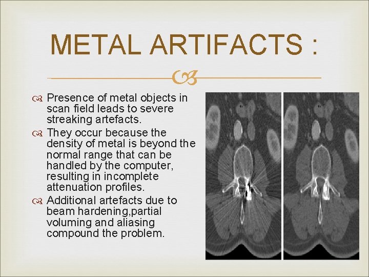 METAL ARTIFACTS : Presence of metal objects in scan field leads to severe streaking