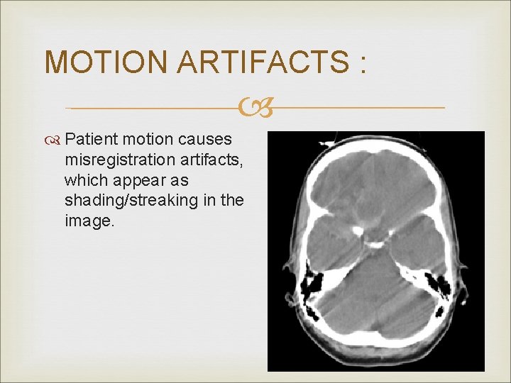 MOTION ARTIFACTS : Patient motion causes misregistration artifacts, which appear as shading/streaking in the