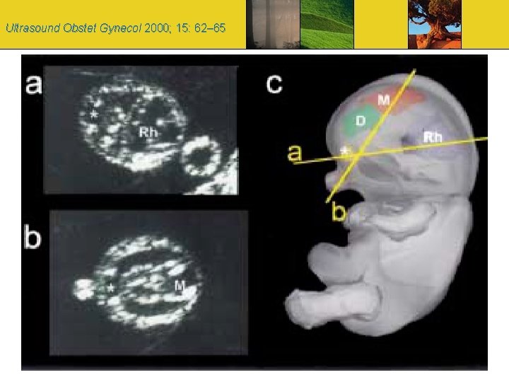 Ultrasound Obstet Gynecol 2000; 15: 62– 65 