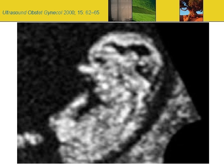 Ultrasound Obstet Gynecol 2000; 15: 62– 65 