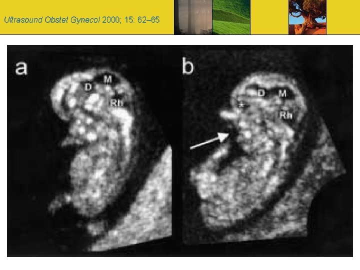 Ultrasound Obstet Gynecol 2000; 15: 62– 65 