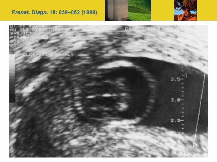 Prenat. Diagn. 19: 859– 862 (1999) 