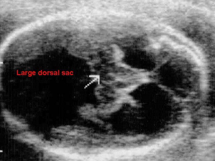 Large dorsal sac 