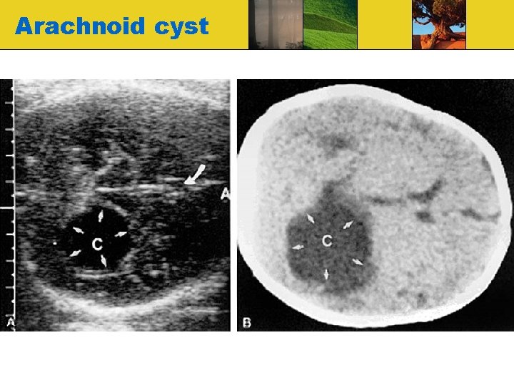Arachnoid cyst 
