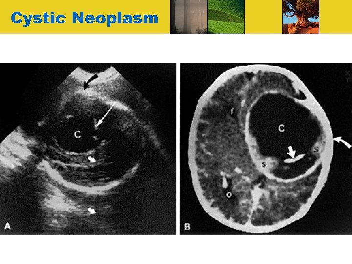 Cystic Neoplasm 