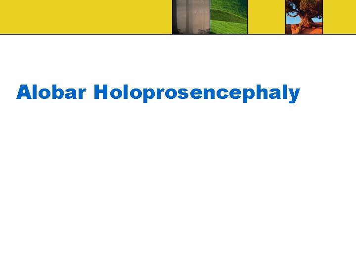 Alobar Holoprosencephaly 