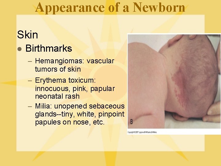 Appearance of a Newborn Skin l Birthmarks – Hemangiomas: vascular tumors of skin –