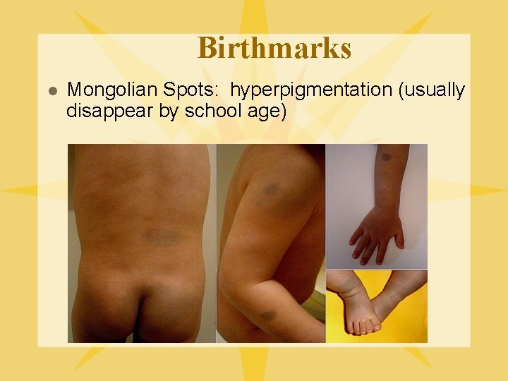 Birthmarks l Mongolian Spots: hyperpigmentation (usually disappear by school age) 