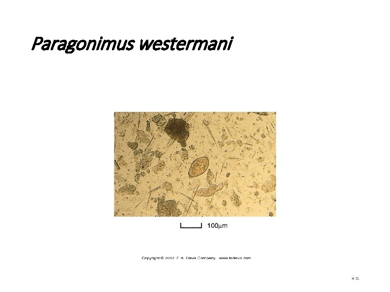 Paragonimus westermani 4 -31 