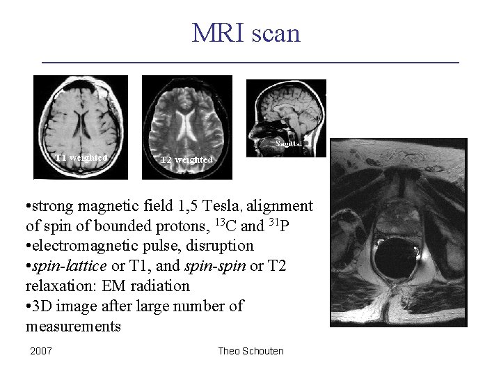 MRI scan • strong magnetic field 1, 5 Tesla, alignment of spin of bounded