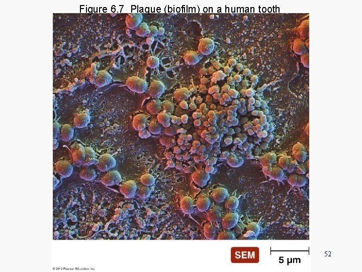 Figure 6. 7 Plaque (biofilm) on a human tooth 52 