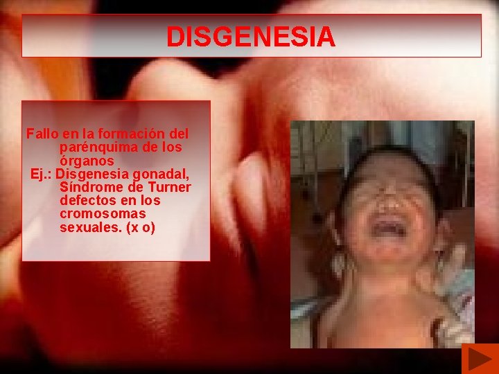 DISGENESIA Fallo en la formación del parénquima de los órganos Ej. : Disgenesia gonadal,