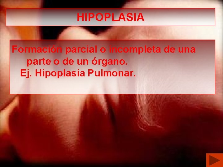 HIPOPLASIA Formación parcial o incompleta de una parte o de un órgano. Ej. Hipoplasia