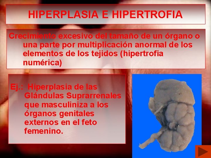 HIPERPLASIA E HIPERTROFIA Crecimiento excesivo del tamaño de un órgano o una parte por