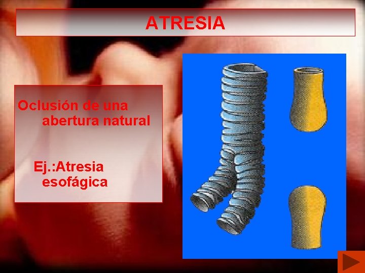 ATRESIA Oclusión de una abertura natural Ej. : Atresia esofágica 