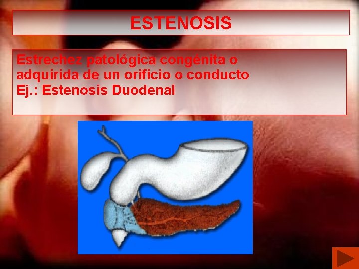 ESTENOSIS Estrechez patológica congénita o adquirida de un orificio o conducto Ej. : Estenosis