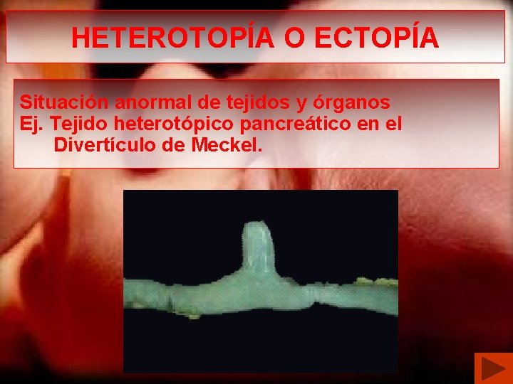 HETEROTOPÍA O ECTOPÍA Situación anormal de tejidos y órganos Ej. Tejido heterotópico pancreático en