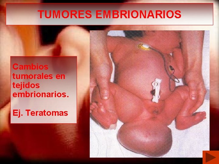 TUMORES EMBRIONARIOS Cambios tumorales en tejidos embrionarios. Ej. Teratomas 