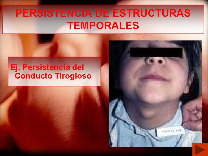 PERSISTENCIA DE ESTRUCTURAS TEMPORALES Ej. Persistencia del Conducto Tirogloso 