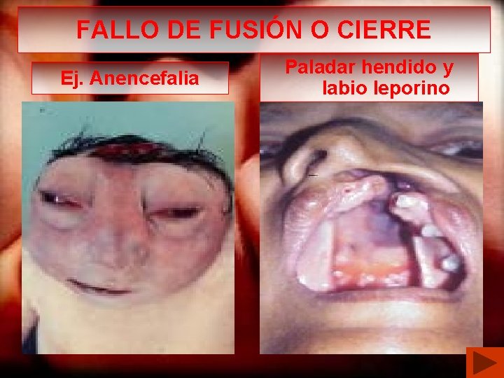 FALLO DE FUSIÓN O CIERRE Ej. Anencefalia Paladar hendido y labio leporino 