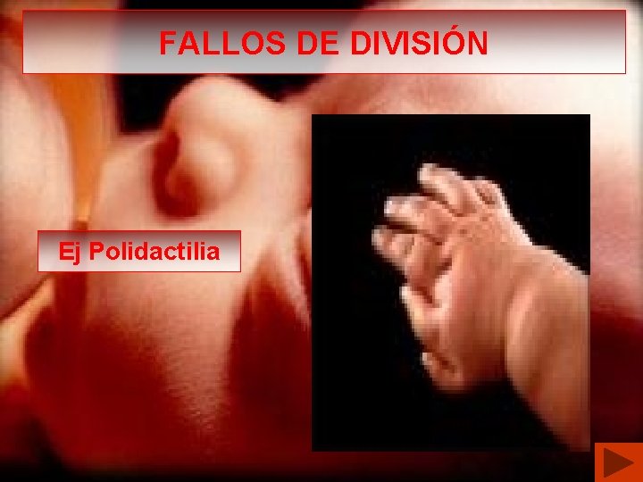 FALLOS DE DIVISIÓN Ej Polidactilia 
