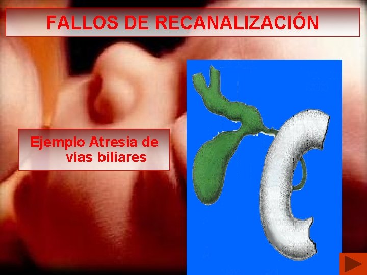 FALLOS DE RECANALIZACIÓN Ejemplo Atresia de vías biliares 
