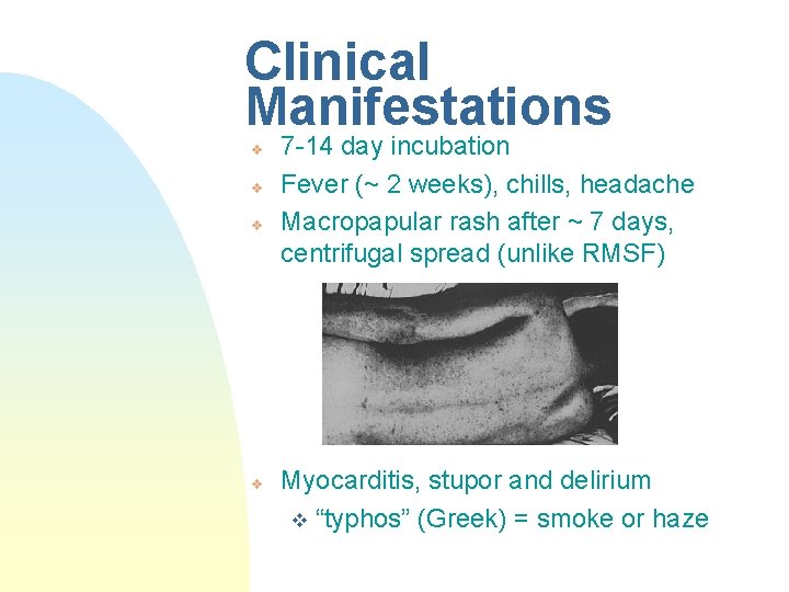 Clinical Manifestations v v 7 -14 day incubation Fever (~ 2 weeks), chills, headache