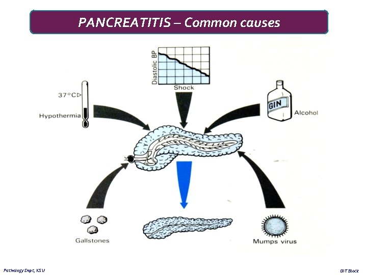 PANCREATITIS – Common causes Pathology Dept, KSU GIT Block 
