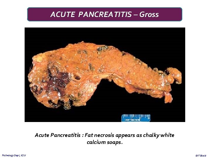 ACUTE PANCREATITIS – Gross Acute Pancreatitis : Fat necrosis appears as chalky white calcium